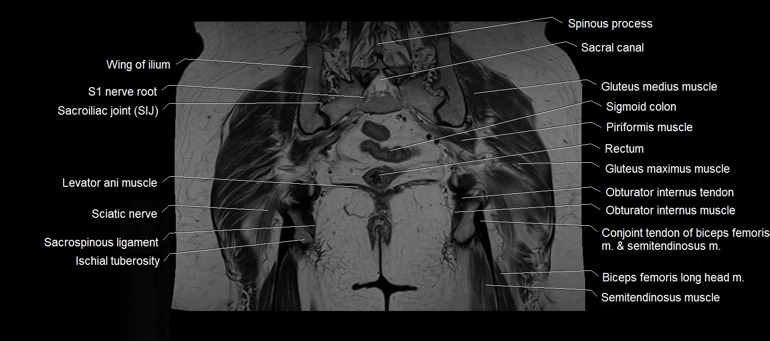 MRI 3T pelvis coronal cross section anatomy image 20.webp